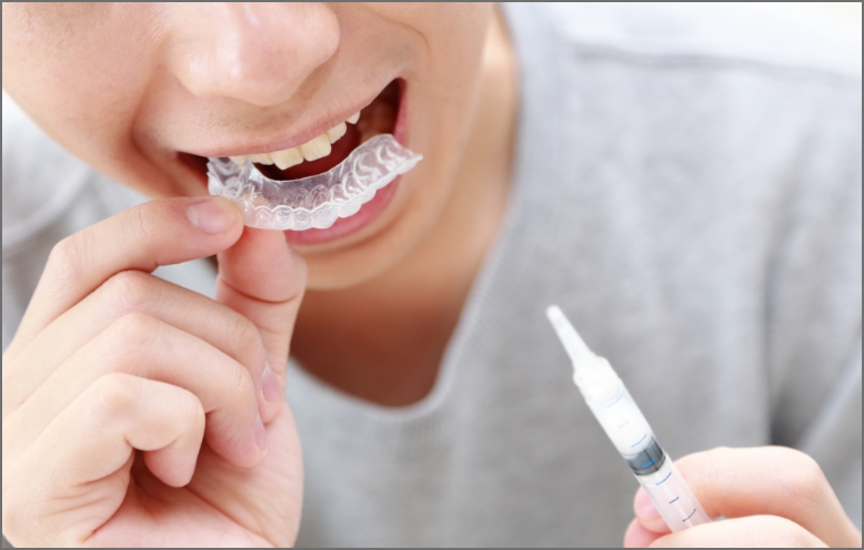 憧れの白い歯にできるホワイトニングをご存じですか？